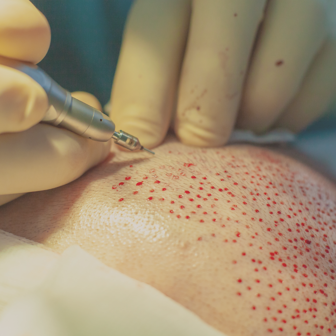 FUE hair transplant