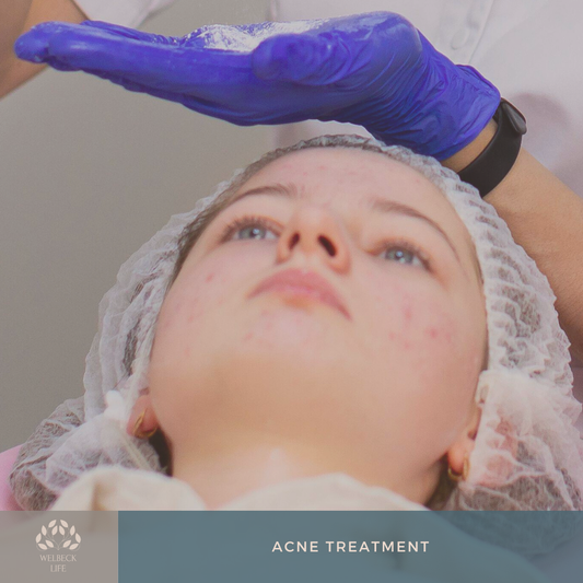 Acne treatment London