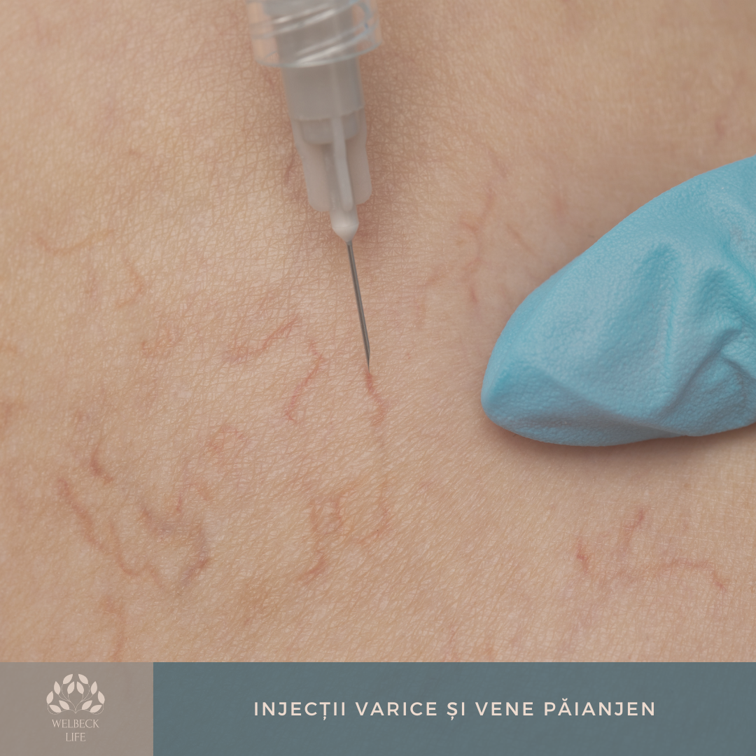 Injectii Varice si Vene Paianjen Oradea