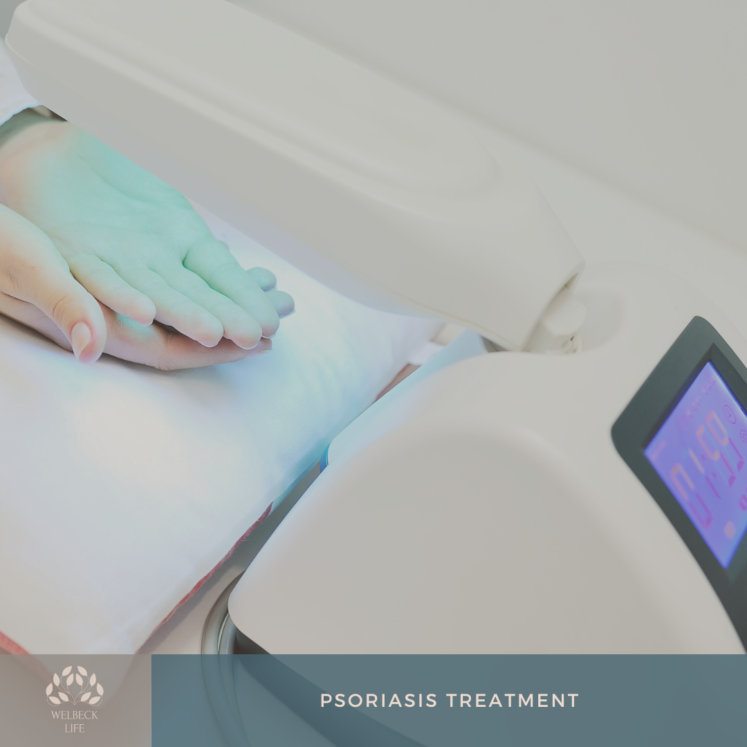 Psoriasis treatment London