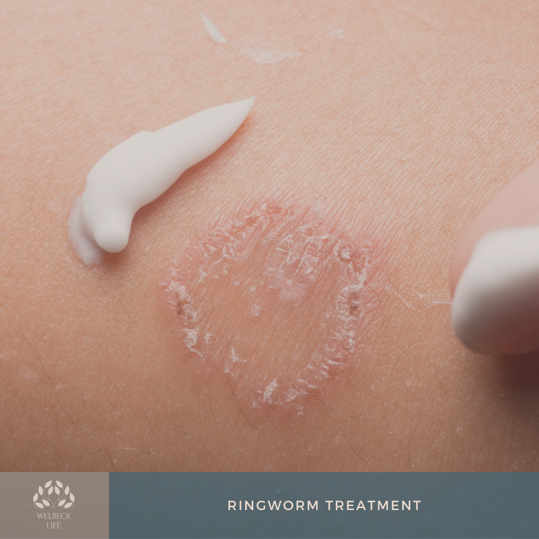 Ringworm treatment London