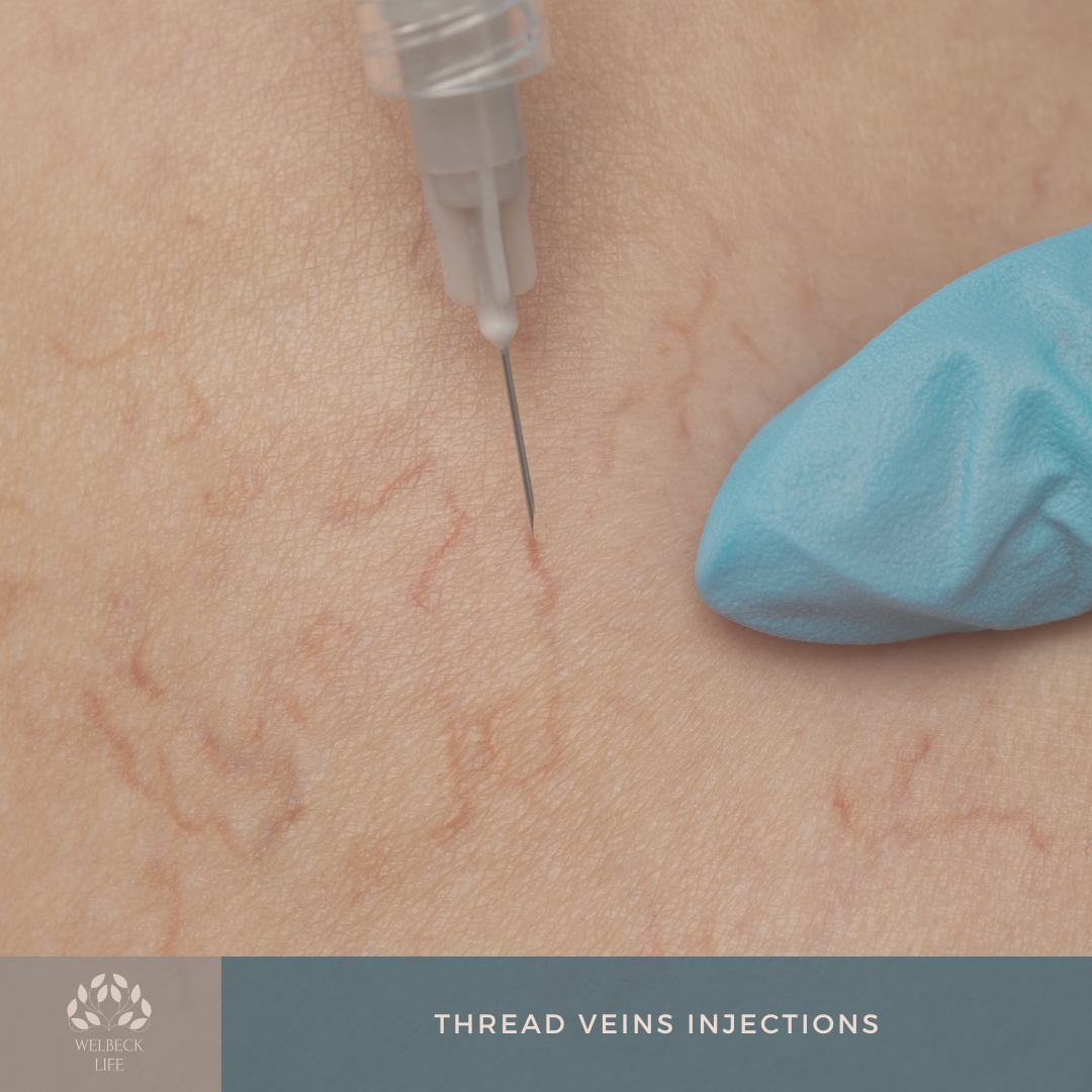 Thread veins injection London