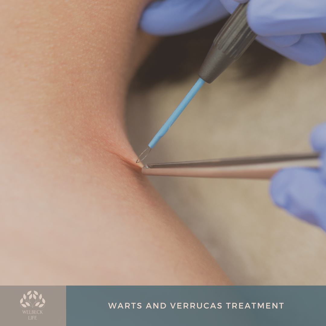 Warts and verrucas treatment London