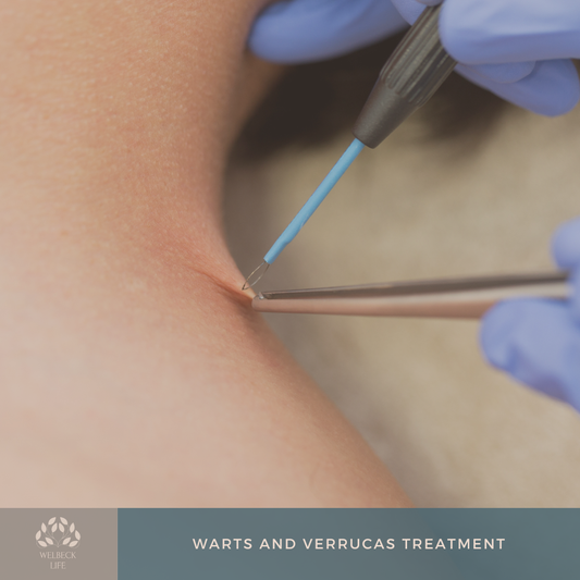 Warts and verrucas treatment London