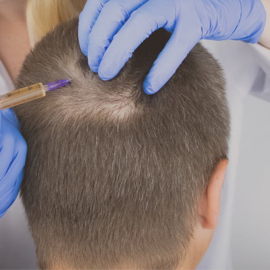 Alopecia Areata Treatment