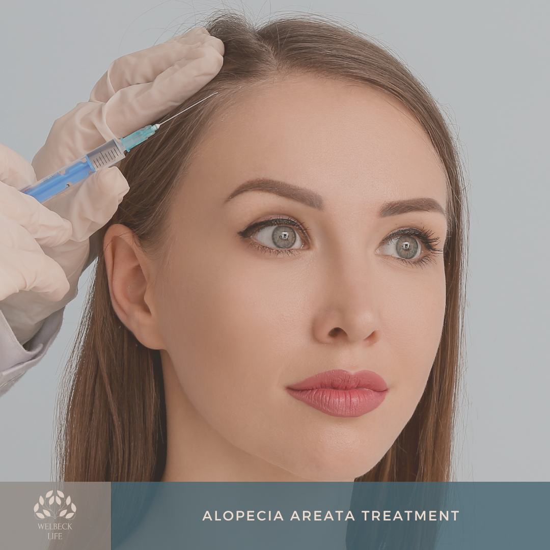 Alopecia areata treatment London