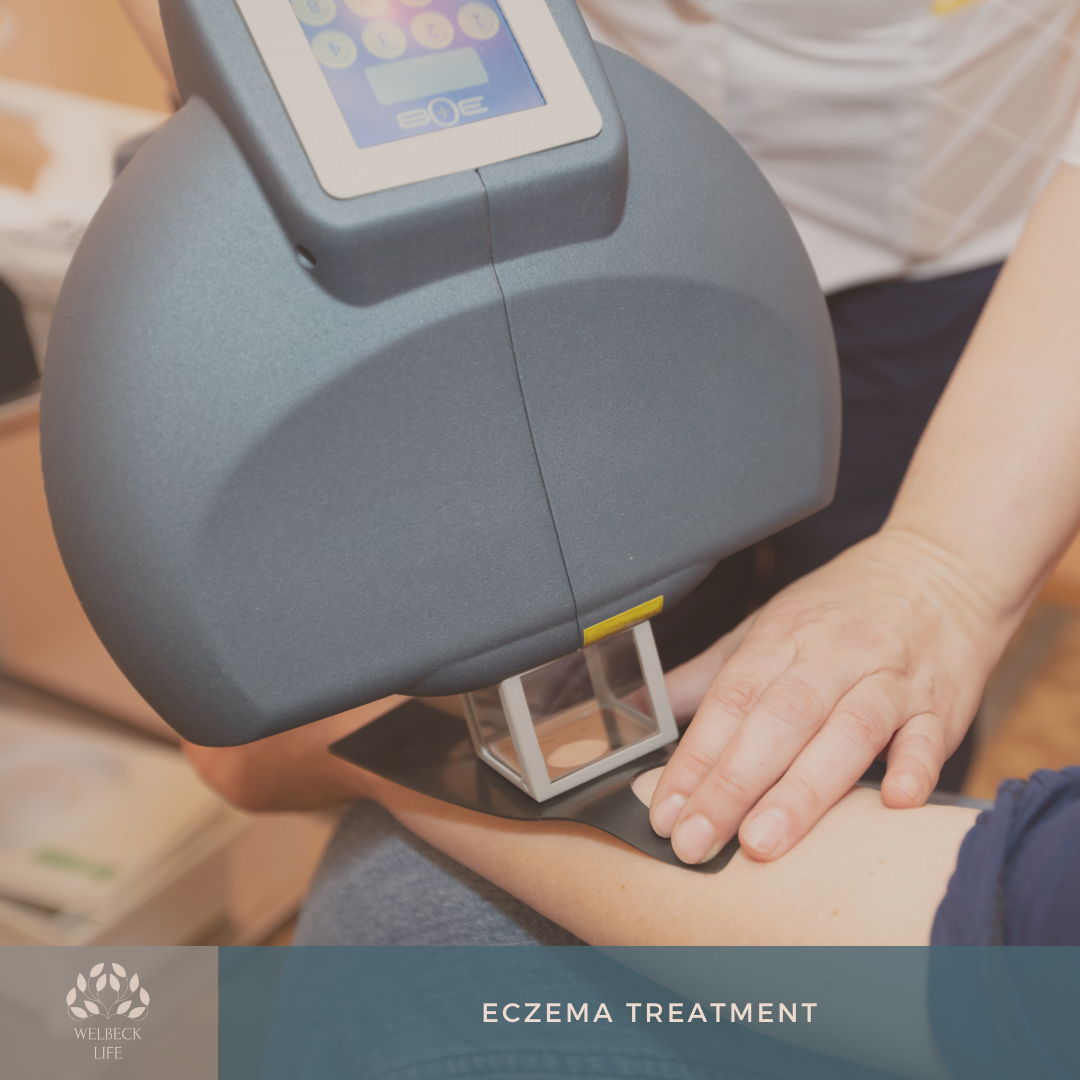 Eczema treatment London