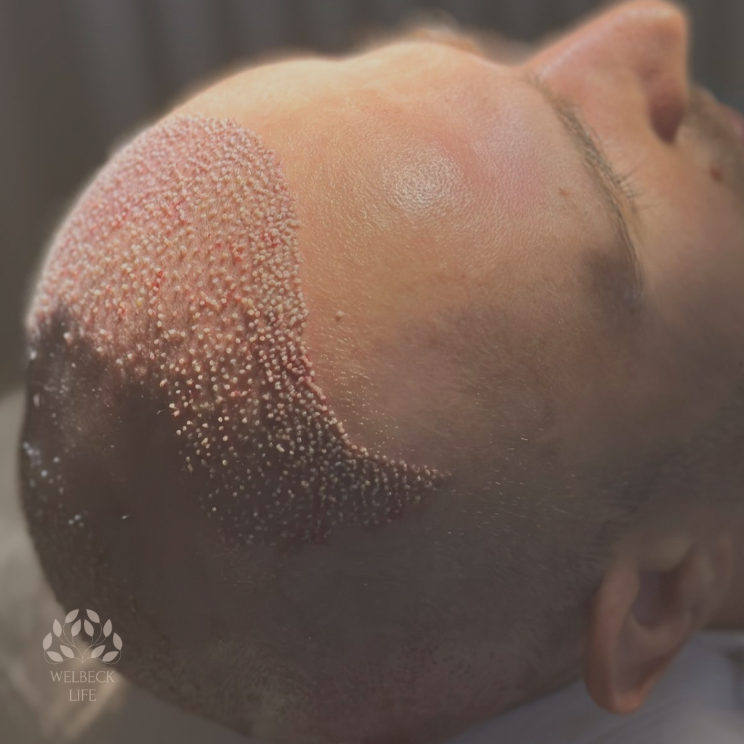 hair transplant London