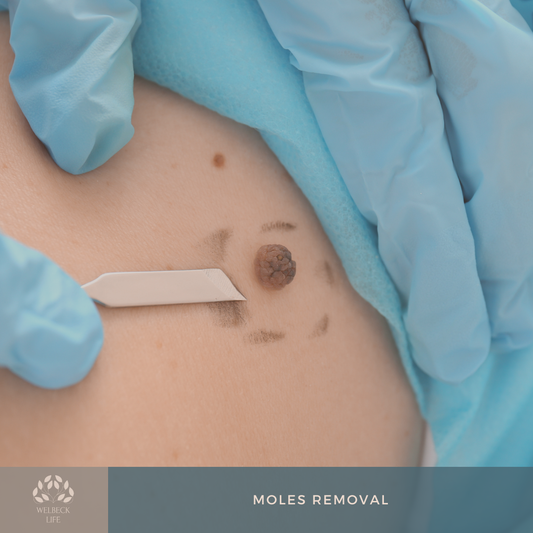 Moles removal London